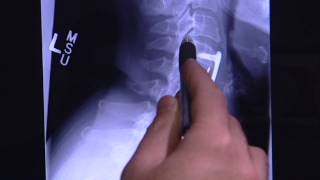 Radiofrequency Ablation for Spine Pain with Dr Steven Barna  Florida Orthopaedic Institute [upl. by Aicilak]