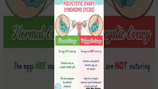 Normal Ovary VS PCOS ovarypcos syndrome viralvideo trending shorts ytshorts [upl. by Nileve]