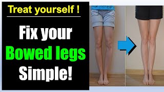 Bowed legs fix Simple bowed legs exercise correction [upl. by Htiduy]