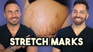 Major Announcement  How to Treat Stretch Marks like a Dermatologist [upl. by Sion]