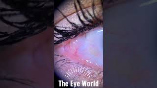 conjunctival cyst [upl. by Lorusso]