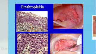 Omneya Wahba Premalignant Lesions 2 [upl. by Smada]