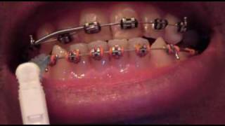 Week 33 in braces  massive movement [upl. by Ttergram]