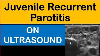 Juvenile Recurrent Parotitis On Ultrasound [upl. by Alliuqa865]