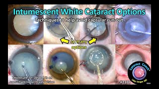 CataractCoach™ 2377 options for intumescent white cataracts [upl. by Meesaw26]