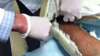 Total Contact Cast removal [upl. by Aihsat]