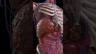 Cirrhosis Liver Under Siege 3dmodel meded anatomy [upl. by Berfield]