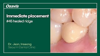 Clinical Case LW Implant placement on 45 healed ridge [upl. by Noelyn710]