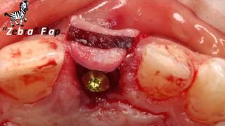 BEST Implant Flap Design PART 2 [upl. by Annehsat863]