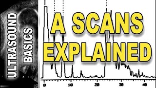 ultrasound  A scans explained [upl. by Ogeid]