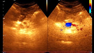 Ultrasonogram of Chronic Pancreatitis Key Findings and Diagnosis  Chronic Pancreatitis [upl. by Leibarg]