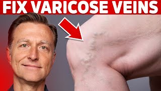 How to Treat Varicose Veins Naturally – Dr Berg [upl. by Lamee]