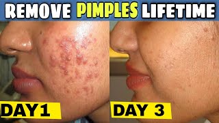 Remove PIMPLES OVERNIGHT  Remove ACNE LIFETIME  ACNE Treatment  IN TAMIL [upl. by Gnat]