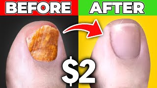 Get Rid Of Toenail Fungus for Good for Only 200 [upl. by Ahsaeyt]