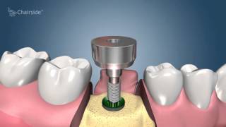 Dental Implant Procedure  Two Stage 🦷 Award Winning Patient Education [upl. by Crandell]