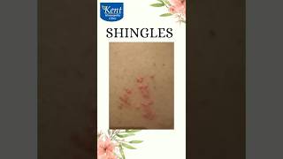 Shingles Best homeopathy treatment Drkukreja kalani online consult8291492566 [upl. by Annayd]