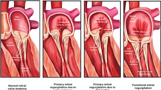 Quantification Of Valvular Heart Disease Severity Challenges And Solutions [upl. by Atinihc]