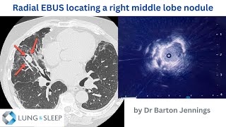 Radial EBUS locating a nodule adjacent to the diaphragm [upl. by Ittam]