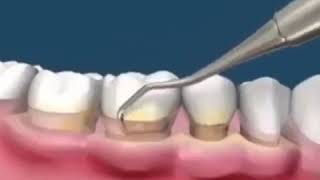 Teeth scaling and polishing [upl. by Oirobil]