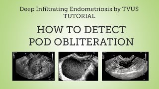 Pouch of Douglas Obliteration Detection by TVUS Tutorial [upl. by Poliard]