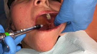 Inferior Alveolar and Lingual Nerve Blocks [upl. by Stclair]