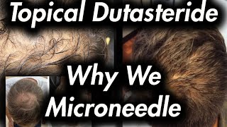 Topical Dutasteride amp Microneedling Why It Helps [upl. by Ttenyl]