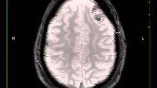 Meningioma left frontal [upl. by Joceline726]