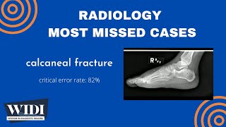 Most Missed Cases Calcaneal Fracture [upl. by Etnoj352]