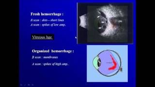 Ophthalmic ultrasonography  2vitreous cavity [upl. by Slohcin]