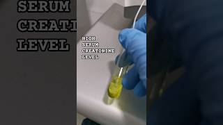 High Serum Creatinine Level chemistry laboratory cls medtechstudent mls bloodtest bloodchem [upl. by Dnalrag]