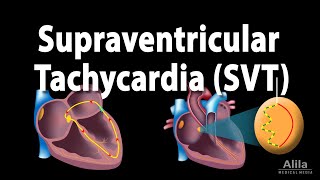 Supraventricular Tachycardia SVT PSVT Animation [upl. by Ardnas]