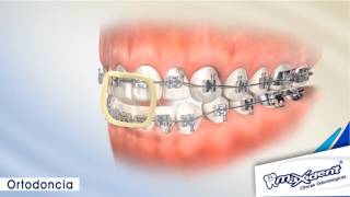 Corrección de mordida y espacios dentales quotOrtodonciaquot [upl. by Mirielle734]