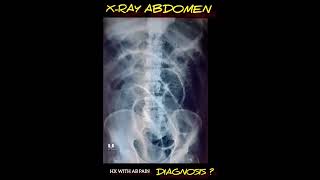 Diagnosis  X Ray Abdomen  Radiology [upl. by Sieber445]