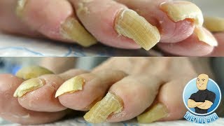 LONG TOENAILS FOR DAYS  TOENAIL CUTTING PART 1 [upl. by Erdnaek143]