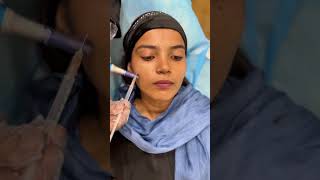 Microneedling treatment for scars skincare microneedling acne scars trendingshorts viralvideo [upl. by Austina]