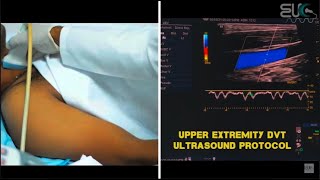 Upper Extremity DVT Ultrasound Protocol [upl. by Atirehgram]