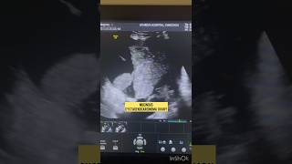 Ovarian cancer  Mucinous cystadenoCarcinoma  ultrasound cancer [upl. by Stuart309]