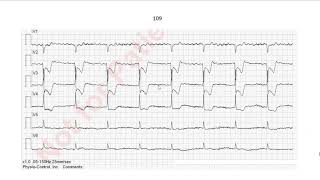 EKG in 3 Minuten 10 [upl. by Animsay]