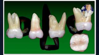 Módulo I  Aula 3 Cirurgia de Acesso  Molares Superiores [upl. by Enaile]