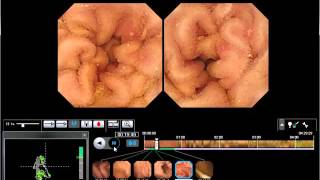 WEO Video Capsule Endoscopy VCE Library clinical case 31 [upl. by Ohcamac]