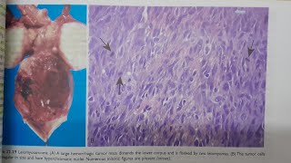 Leiomyosarcoma  SPECIAL PATHOLOGY [upl. by Alegnad414]