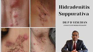 Hidradenitis suppurativa  pathogenesis and management [upl. by Benjamen]