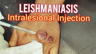 Leishmaniasis Treatment [upl. by Vadnee]