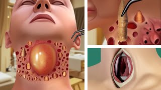 ASMR Removes foreign objects in throat amp Large pustules  Deep Cleaning Animation [upl. by Annahsit]