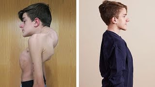 John Sarconas Testimonial  Overcoming Severe Scoliosis and Kyphosis [upl. by Eelyk235]