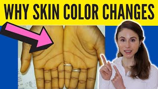 WHY YOUR SKIN COLOR CHANGES  Dermatologist DrDrayzday [upl. by Oirevas]