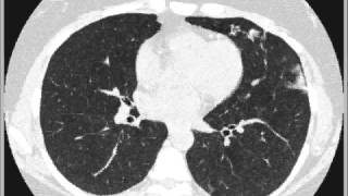 Hypersensitivity pneumonitis [upl. by Tuckie]