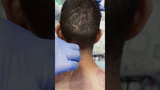 Dry needling therapy for dryneedling mannatpc ytshorts [upl. by Weyermann]