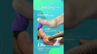 Hallux Limitus  Arthritic big toe joint [upl. by Gorton]