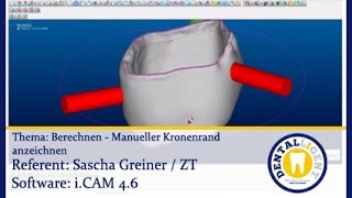 EXOCAD TUTORIAL Teaser  Berechnen iCAM V5 Manuellen Kronenrand anzeichnen [upl. by Neelyk]